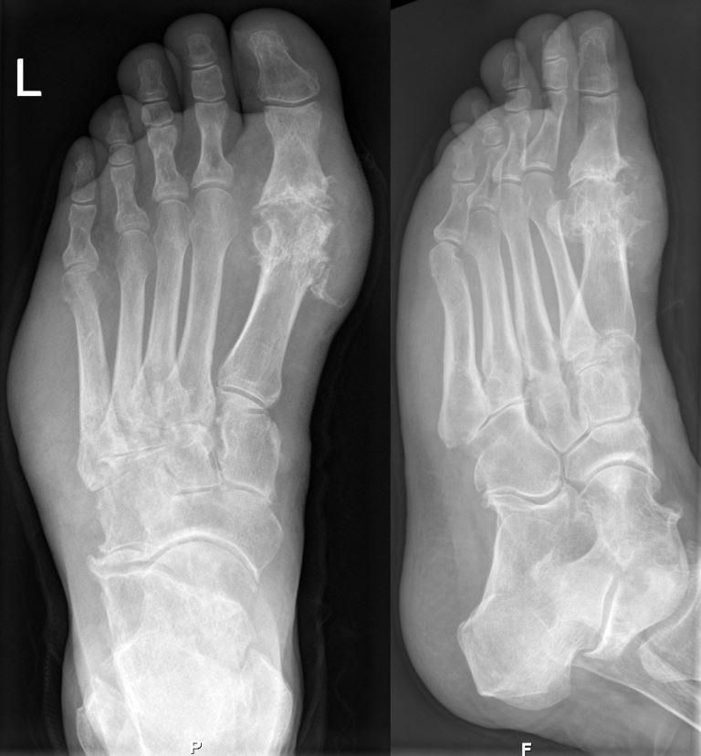 liječenje osteoartritisa poltava samo- masaža boli u ramenima