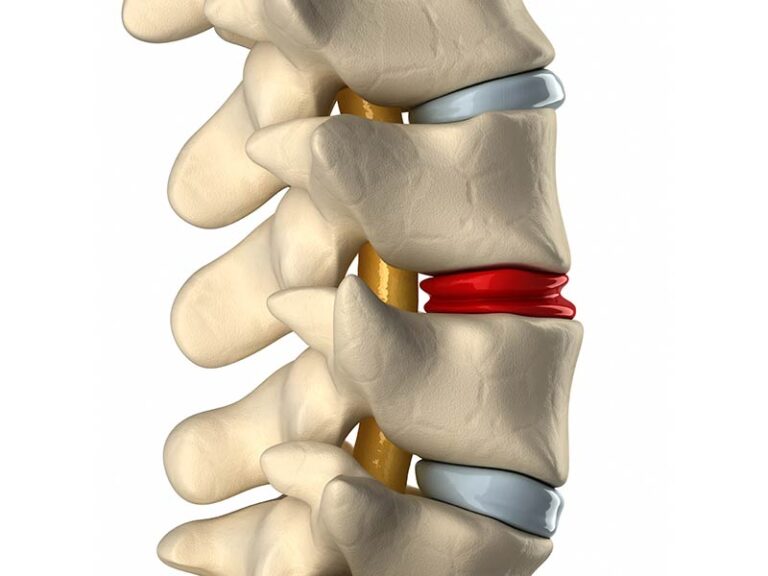 Diskus hernija